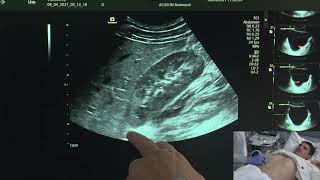 Ultrasound of the Urinary Tract [upl. by Philipines]