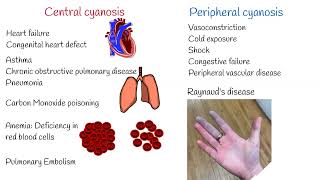 Cyanosis Symptoms and Causes Central and Peripheral Cyanosis [upl. by Atires503]