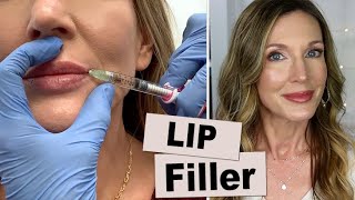 My Experience Getting Lip Filler for Vertical Wrinkles [upl. by Nomal]