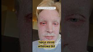 Topical Steroid Withdrawal eczema shorts [upl. by Nwahshar890]