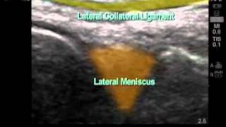 How To Lateral Meniscus Ultrasound Exam [upl. by Suzie21]