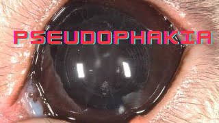 Pseudophakia  Artephakia  Ophthalmology Lecture [upl. by Uranie481]