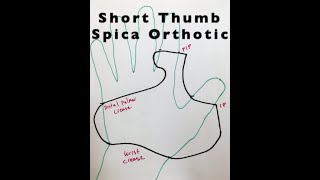 Short thumb spica OrthoticSplint in Hand Therapy Setting [upl. by Russo]