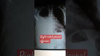 Pleural effusion  right [upl. by Breed]