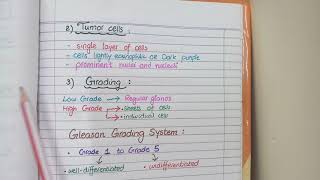 Prostate Carcinoma Pathology  Morphology and Gleason Grading [upl. by Trab79]