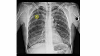 Pneumothorax Röntgen Beispiele erklärt [upl. by Austen]