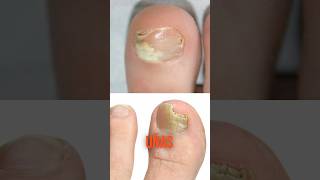 Así debes tratar los hongos en las uñas de los pies 🦶 onicomicosis uñas hongo tratamiento [upl. by Zetnod]