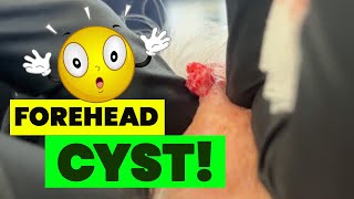 FOREHEAD CYST [upl. by Adni688]