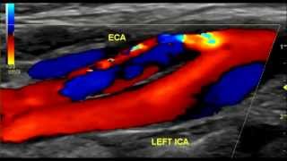 Carotid Artery Dissection Ultrasound [upl. by Novihc]