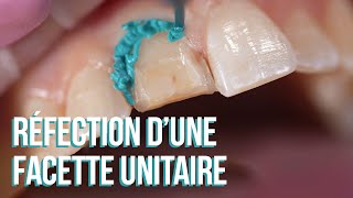 📹 Tuto clinique 02  Réfection dune facette unitaire [upl. by Aihsiyt540]