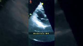 Moderate Mitral Stenosis mitral valve shorts heartknowledge cathlab [upl. by Spearman]