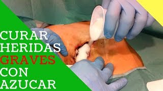 👨‍🔬Como CICATRIZAR Heridas GRAVES Con AZUCAR  Otros USOS Del AZUCAR 👈 [upl. by Amalie957]