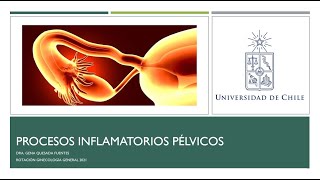 ENFERMEDAD INFLAMATORIA PÉLVICA – DRA GENA QUESADA FUENTES [upl. by Whitnell]