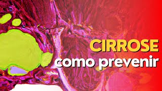 Como prevenir a cirrose hepática  Entenda a prevenção da hepatite  Prof Dr Victor Proença [upl. by Wolgast]