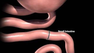 Rex Bariatrics Gastric Bypass Surgery Explained [upl. by Asiek377]