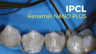 Use IPCL to restore minimallyinvasive cavity preparations [upl. by Sheree99]