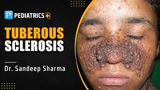 Tuberous Sclerosis by Dr Sandeep Sharma  PrepLadder NEET SS [upl. by Dijam]