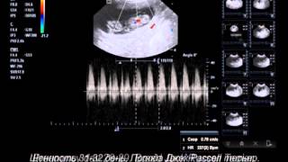 Ultrasonography Pregnant dogs 2132 days [upl. by Eladnek868]