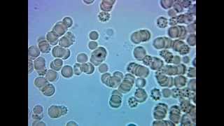 Lyme Disease Borrelia Burgdorferi forms a Cyst [upl. by Faus]