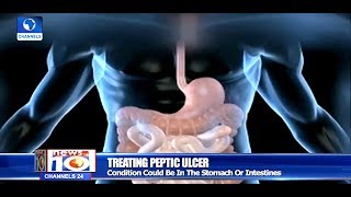 How To Treat Peptic Ulcer Health Focus [upl. by Leese]