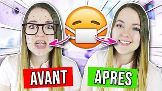 AVOIR UN APPAREIL DENTAIRE  AVANT VS APRES [upl. by Duer]