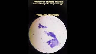 Cysticercosis Taenia solium parasitic infectionPathologyFNACCytology smear [upl. by Suilenrac]