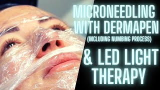 DERMAPEN MICRONEEDLING amp CELLUMA LED LIGHT THERAPY  ANTIAGING SKIN CARE  FINE LINES amp WRINKLES [upl. by Monjan]