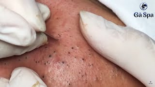 Best Blackhead Removal Ever 55min  Facial Acne Treatment  Gà Spa [upl. by Eilata]