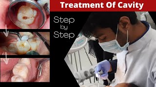 Composite Filling Step by Step  Cavity In Tooth  How To Fill Decayed Tooth  Dr Sunil Kumar [upl. by Tila]