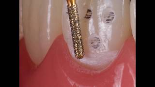 Minimally Invasive Ceramic Restorations [upl. by Disharoon88]