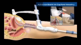 TSPeC® Illustrated Procedure  German [upl. by Airdni115]