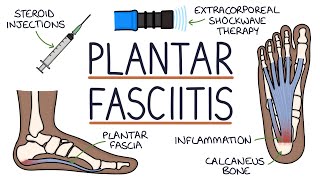 Understanding Plantar Fasciitis [upl. by Erasmo462]