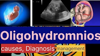 Oligohydramnios causes Diagnosismanagement Dr Naima Bano [upl. by Shell]