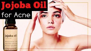 Jojoba Oil for Acne Does It Work And How To Use It [upl. by Wylma]