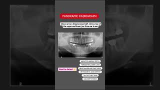 What is OPG or Orthopantomogram X ray [upl. by Yci]