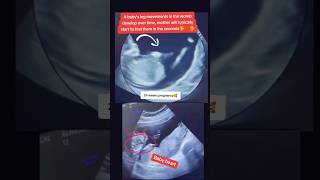 Baby Arms and legs movements inside womb pregnancy 🥰🥰viralvideo trending viralshorts [upl. by Joceline841]