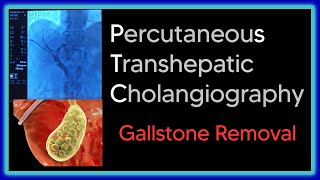 Gallstone Removal using PTC Cholangiography [upl. by Kcirtemed743]