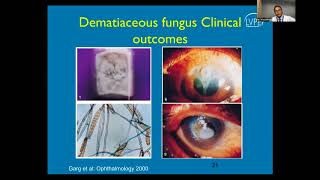 Lecture Fungal Keratitis [upl. by Lucrece]