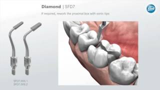 Preparation rules for ceramic inlays and partial crowns [upl. by Garrick]