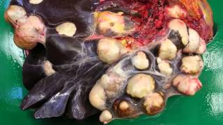 Hydatid cyst liver cyst due to Echinococcus infection [upl. by Salamone]