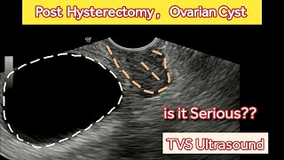 Post Hysterectomy Ovarian Cyst  TVS Ultrasound [upl. by Riatsila767]