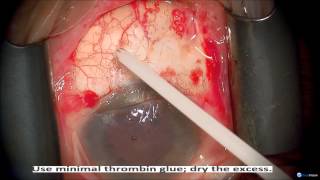 Primary Pterygium Surgery with AmnioGraft Neel Desai MD [upl. by Ecenaj]