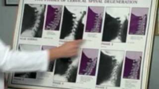 Xray Analysis After Car Accident by Personal Injury Doctor in Columbus Ohio [upl. by Ced16]