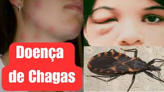 Doença de Chagas o que você precisa saber [upl. by Ylhsa843]