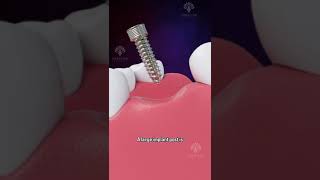 Bone Grafting for Dental Implants shorts facts  creativelearning3d [upl. by Aneekal]