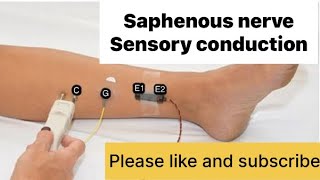 SAPHENOUS NERVE sensory nerve NCS neurology neurotech [upl. by Enehs]