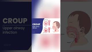 Barking cough in Croup [upl. by Halley]