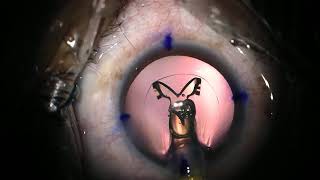 physiol toric trifocal IOL implantation [upl. by Ahsinrad]