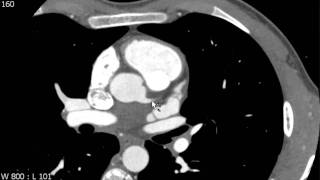 Left Main Coronary Artery on Axial Coronary CTA [upl. by Guinevere510]