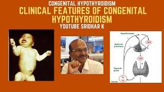 Clinical features of congenital hypothyroidism hypothyroidism clinicalfeatures [upl. by Gelasius238]